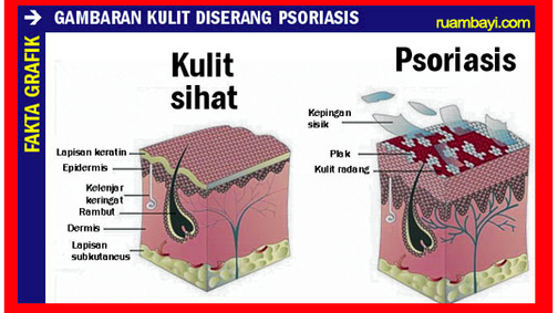 gambaran-kulit-diserang-psoriasis.png