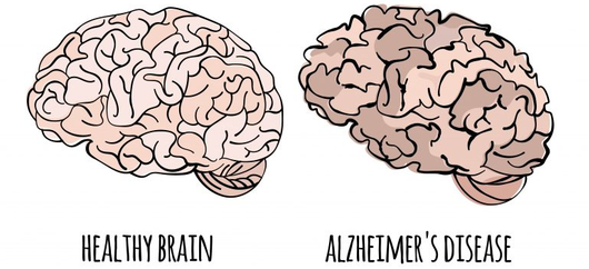 mnet_AlzheimersDiseaseBrainGraphic-768x433.jpg