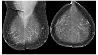 mammography.jpg