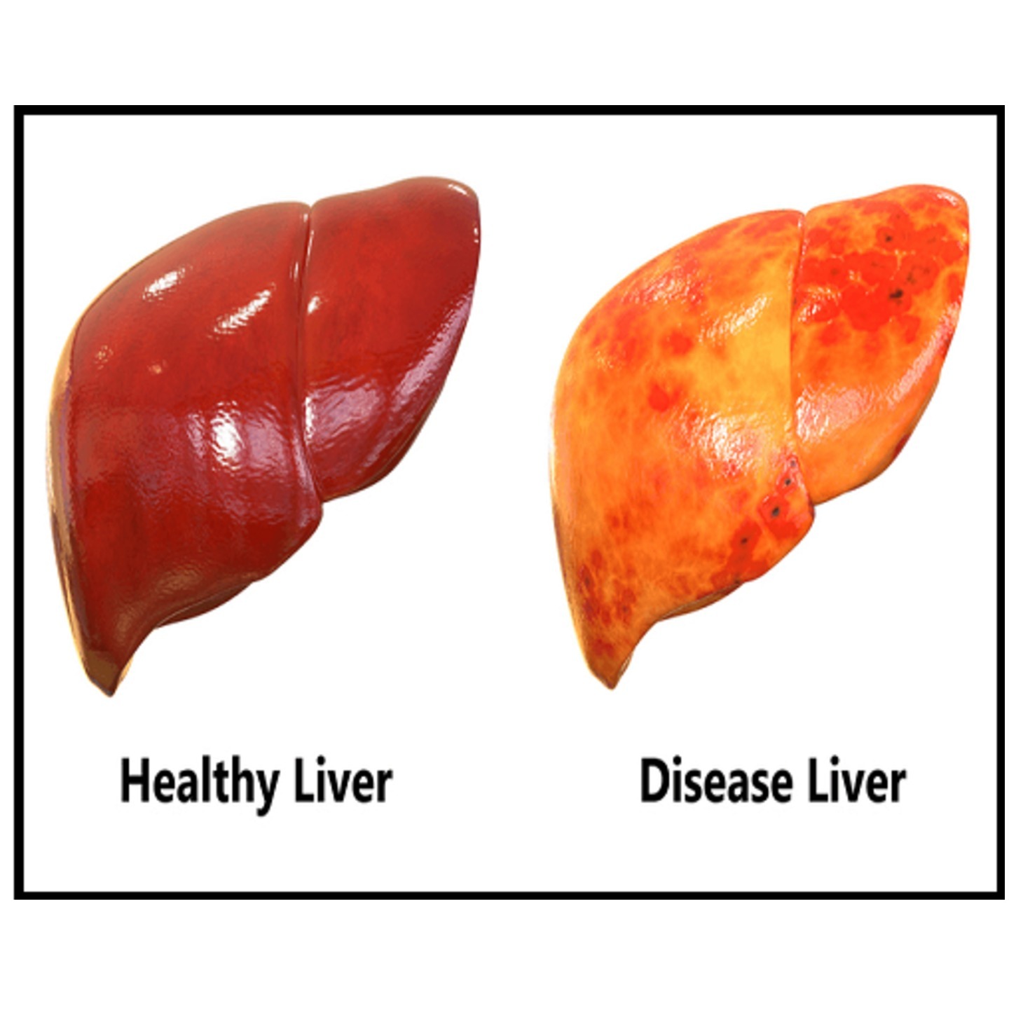 Liver, Kidney and Gout
