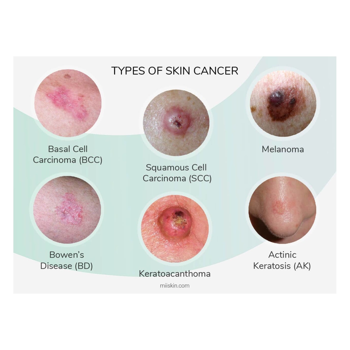Skin Cancer