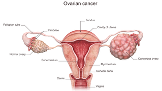 ovary image.jpg